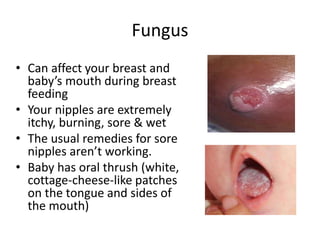 Fungus
• Can affect your breast and
baby’s mouth during breast
feeding
• Your nipples are extremely
itchy, burning, sore & wet
• The usual remedies for sore
nipples aren’t working.
• Baby has oral thrush (white,
cottage-cheese-like patches
on the tongue and sides of
the mouth)
 
