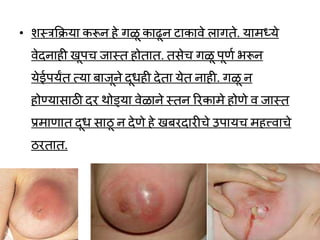 • शस्त्रकिया करून हे गळू काढून टाकार्े लागते. यामध्ये
र्ेदनाही खूपच जास्त होतात. तसेच गळू पूणव भरून
येईपयंत त्या बाजूने दूर्ही देता येत नाही. गळू न
होण्यासाठी दर र्ोड्या र्ेळाने स्तन ररकामे होणे र् जास्त
प्रमाणात दूर् साठू न देणे हे खबरदारीचे उपायच महत्त्र्ाचे
ठरतात.
 