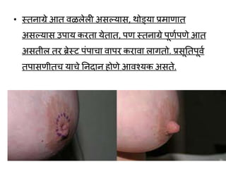 • स्तनाग्रे आत र्ळलेली असल्लयास, र्ोड्या प्रमाणात
असल्लयास उपाय करता येतात, पण स्तनाग्रे पूणवपणे आत
असतील तर ब्रेस्ट पांपाचा र्ापर करार्ा लागतो. प्रसूततपूर्व
तपासणीतच याचे तनदान होणे आर्श्यक असते.
 