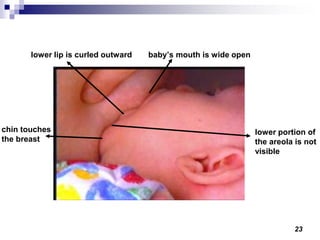 23
baby’s mouth is wide openlower lip is curled outward
lower portion of
the areola is not
visible
chin touches
the breast
 