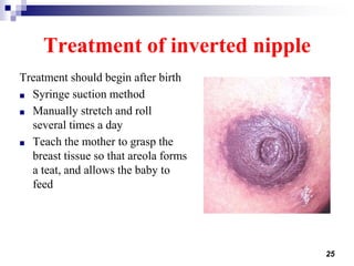 Treatment of inverted nipple
Treatment should begin after birth
■ Syringe suction method
■ Manually stretch and roll
several times a day
■ Teach the mother to grasp the
breast tissue so that areola forms
a teat, and allows the baby to
feed
25
 