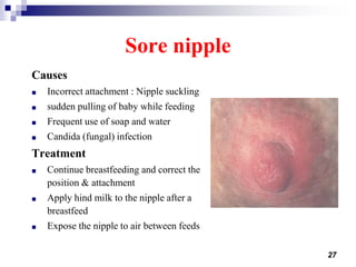 27
Sore nipple
Causes
■ Incorrect attachment : Nipple suckling
■ sudden pulling of baby while feeding
■ Frequent use of soap and water
■ Candida (fungal) infection
Treatment
■ Continue breastfeeding and correct the
position & attachment
■ Apply hind milk to the nipple after a
breastfeed
■ Expose the nipple to air between feeds
 