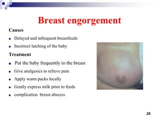28
Breast engorgement
Causes
■ Delayed and infrequent breastfeeds
■ Incorrect latching of the baby
Treatment
■ Put the baby frequently to the breast
■ Give analgesics to relieve pain
■ Apply warm packs locally
■ Gently express milk prior to feeds
■ complication breast abscess
 