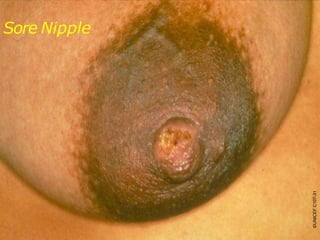 UNICEF/WHO Breastfeeding Promotion and Support in a Baby-Friendly Hospital – 20 hour Course 2006
Sore Nipple
©UNICEFC107-31
 