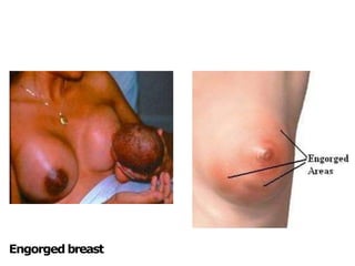 Engorged breast
 