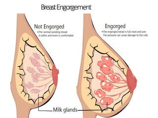 UNICEFC-107-19
BreastEngorgement
12/3
 