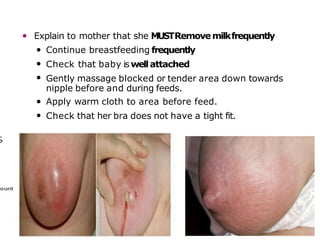 • Explain to mother that she MUSTRemovemilkfrequently
•
•
•
Continue breastfeeding frequently
Check that baby iswellattached
Gently massage blocked or tender area down towards
nipple before and during feeds.
Apply warm cloth to area before feed.
Check that her bra does not have a tight fit.
•
•
38
 