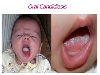 Oral Candidiasis
 