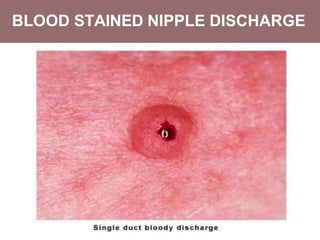 BLOOD STAINED NIPPLE DISCHARGE
 