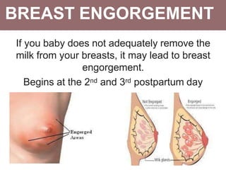 BREAST ENGORGEMENT
If you baby does not adequately remove the
milk from your breasts, it may lead to breast
engorgement.
Begins at the 2nd and 3rd postpartum day
 