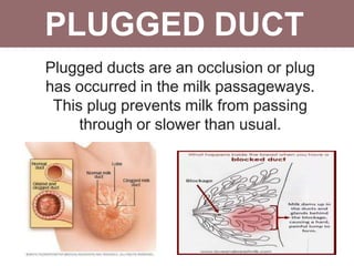 PLUGGED DUCT
Plugged ducts are an occlusion or plug
has occurred in the milk passageways.
This plug prevents milk from passing
through or slower than usual.
 