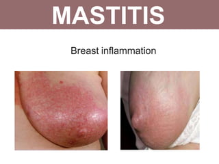 MASTITIS
Breast inflammation
 