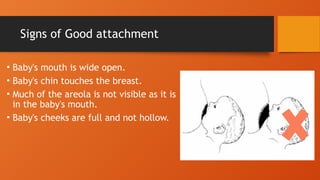 Signs of Good attachment
• Baby's mouth is wide open.
• Baby's chin touches the breast.
• Much of the areola is not visible as it is
in the baby's mouth.
• Baby's cheeks are full and not hollow.
 