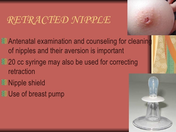 milano-cracked-nipples-when-breastfeeding