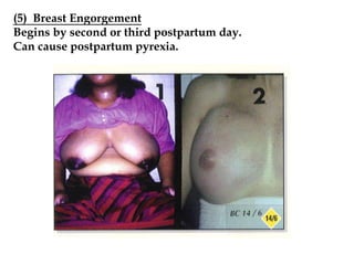 (5) Breast Engorgement
Begins by second or third postpartum day.
Can cause postpartum pyrexia.
 
