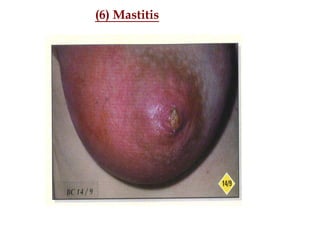 (6) Mastitis
 