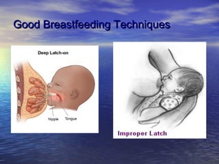 Good Breastfeeding TechniquesGood Breastfeeding Techniques
 