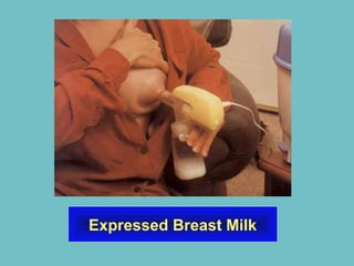 Expressed Breast Milk
 