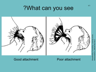 What can you see?
Good attachment Poor attachment
6/3
BreastfeedingCounselling:atrainingcourse,
WHO/CHD/93.4,UNICEF/NUT/93.2
 