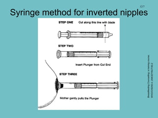 Syringe method for inverted nipples
12/7
BreastfeedingCounselling:atrainingcourse,
WHO/CHD/93.4,UNICEF/NUT/93.2
 