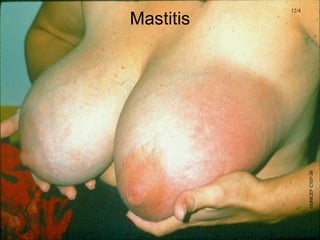 Mastitis
12/4
©UNICEFC107-39
 