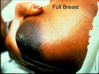 Full Breast
UNICEFC-107-19
12/2
 
