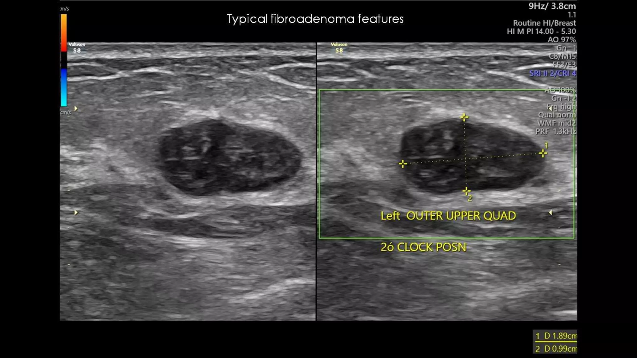 breast-fibroadenoma-imaging-pptx