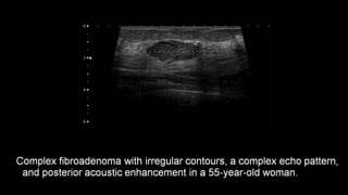 Breast fibroadenoma imaging