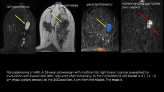 Breast fibroadenoma imaging