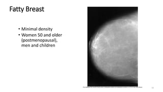 19
Fatty Breast
• Minimal density
• Women 50 and older
(postmenopausal),
men and children
 