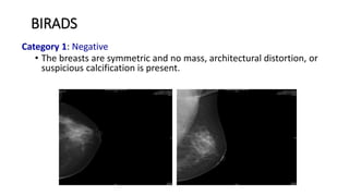 BIRADS
Category 1: Negative
• The breasts are symmetric and no mass, architectural distortion, or
suspicious calcification is present.
 
