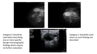 Category 2 should be
used when describing
one or more specific
benign mammographic
findings which require
no further evaluation
Category 1 should be used
when no such findings are
described
 