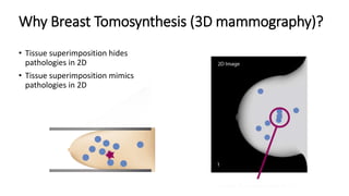 Why Breast Tomosynthesis (3D mammography)?
• Tissue superimposition hides
pathologies in 2D
• Tissue superimposition mimics
pathologies in 2D
 