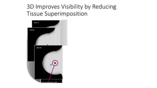 3D Improves Visibility by Reducing
Tissue Superimposition
 