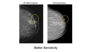 2D Mammogram Tomosynthesis
Better Sensitivity
 