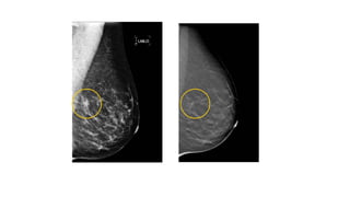 2D Mammogram Tomosynthesis
Fewer Recalls
 