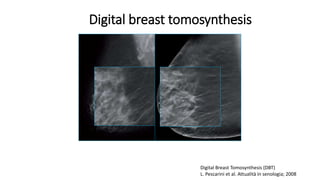 Digital Breast Tomosynthesis (DBT)
L. Pescarini et al. Attualità in senologia; 2008
Digital breast tomosynthesis
 