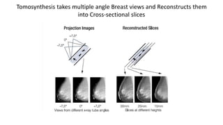 Tomosynthesis takes multiple angle Breast views and Reconstructs them
into Cross-sectional slices
 