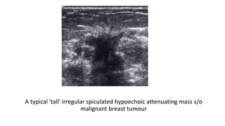 A typical 'tall' irregular spiculated hypoechoic attenuating mass s/o
malignant breast tumour
 