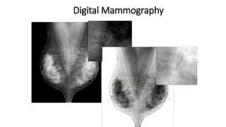 Digital Mammography
 