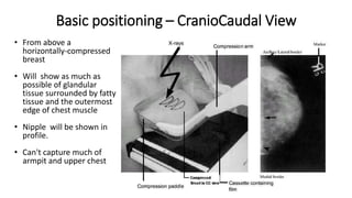 Basic positioning – CranioCaudal View
• From above a
horizontally-compressed
breast
• Will show as much as
possible of glandular
tissue surrounded by fatty
tissue and the outermost
edge of chest muscle
• Nipple will be shown in
profile.
• Can't capture much of
armpit and upper chest
 