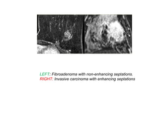 LEFT: Fibroadenoma with non-enhancing septations.
RIGHT: Invasive carcinoma with enhancing septations
 