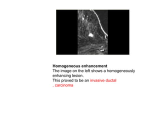 Homogeneous enhancement
The image on the left shows a homogeneously
enhancing lesion.
This proved to be an invasive ductal
carcinoma.
 