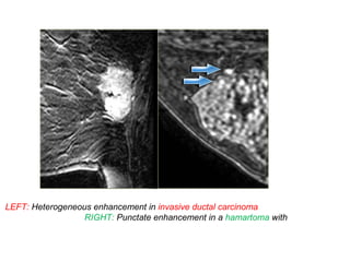 LEFT: Heterogeneous enhancement in invasive ductal carcinoma
RIGHT: Punctate enhancement in a hamartoma with
 