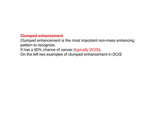 Clumped enhancement
Clumped enhancement is the most important non-mass enhancing
pattern to recognize.
It has a 60% chance of cancer (typically DCIS).
On the left two examples of clumped enhancement in DCIS
 