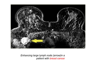 Enhancing large lymph node (arrow)in a
patient with breast cancer
 