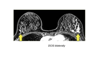 DCIS bilaterally
 