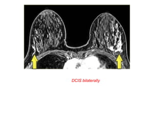 DCIS bilaterally
 