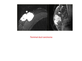 Terminal duct carcinoma
 