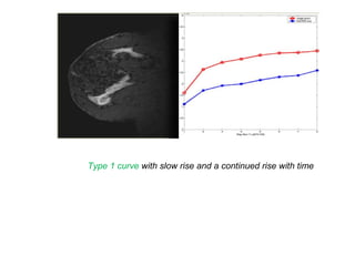 Type 1 curve with slow rise and a continued rise with time
 